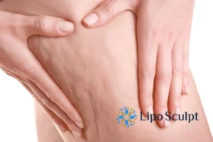 CoolSculpting for Legs: The Innovative Approach to Redefining Your Legs 5 Start your journey today book your coolsculpting treatment Ilkeston online today!